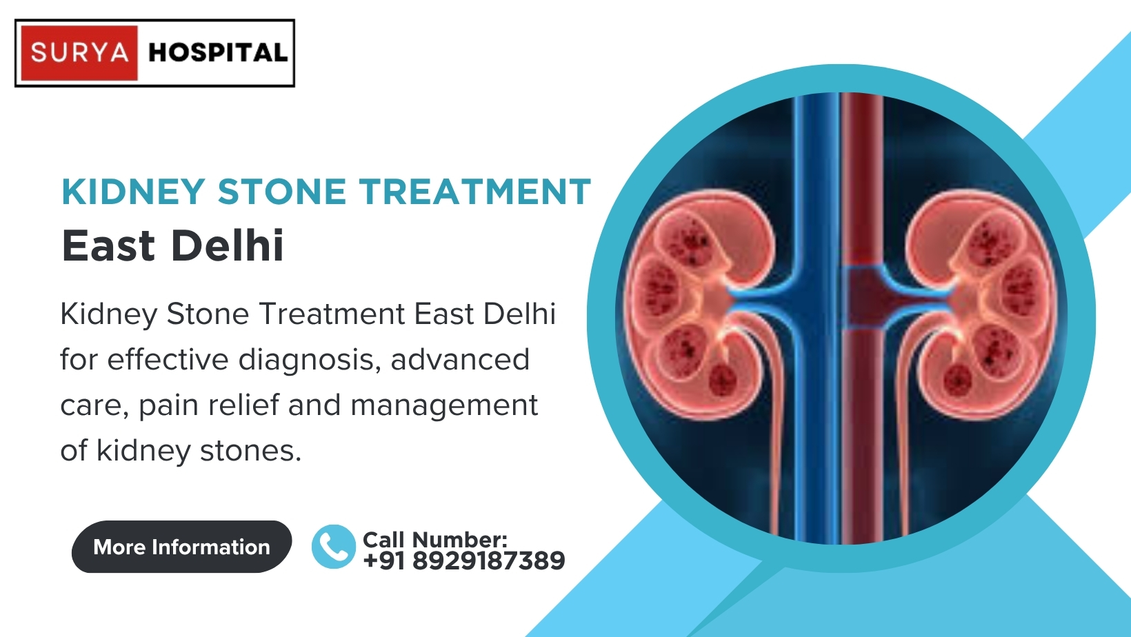 Kidney Stone Treatment East Delhi - Expert Care & Relief